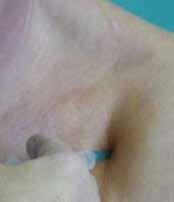 coracoides pod laterální částí klíční kosti - od proc. coracoides 1 cm laterálně a lehce kaudálně je místo vpichu - tam je také maxim.ální palpační bolestivost.