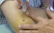 Při vpichu vedeme jehlu proti hlavici a lehce kraniálně do hloubky 2-3 cm a aplikujeme do subakromiální burzy - při aplikaci není cítit odpor. Obr.