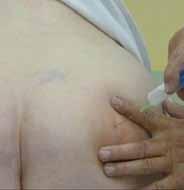 Instilujeme opět anestetikum Mesocain 5-10 ml event. s kortikoidem. Jehlu vedeme kolmo až po kontakt s kostí pacient cítí parestézie v hýždi, stehně, bérci, někdy na hrázi. Obr.