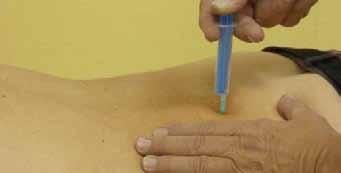 Trn L4 leží v horizontální čáře spojující hřebeny kosti kyčelní. 2-3 cm pravertebrálně zjišťujeme při hluboké palpaci bolestivost.
