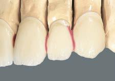 Před prvním dentinovým pálením se u můstku musí separovat jeho jednotlivé členy, a sice vždy interdentálně až na konstrukci.