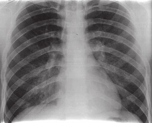 PNEUMONIE S HEMATURIÍ U MLADÉHO MUŽE Obr. č.