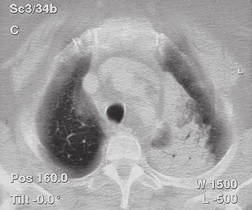 Proto byla indikována fibrobronchoskopie s obrazem infiltrace sliznice bronchu pro levý horní lalok s drobnou granulací při jeho odstupu a stenózy B1, 2 a 3 vlevo na štěrbinu extramurálním tlakem.