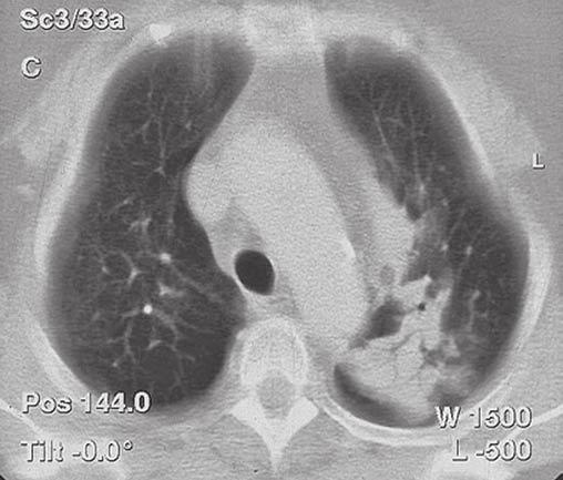 Pacientce jsme provedli kombinované bronchoskopické vyšetření s aspirací z levého horního laloku a s punkcí kariny. Bronchoskopický obraz se oproti prvnímu výkonu nezměnil.