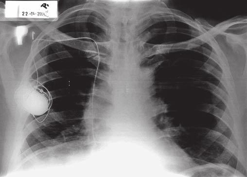 POLYMYOZITIDA S ÚVODNÍ MANIFESTACÍ PŘIPOMÍNAJÍCÍ PNEUMONII Obr. č. 2 Tabulka č. 2: Pleuropulmonální projevy DM-PM (dle: Freemer et al. 2003; Rockall et al.