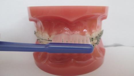 4.3 Pomůcky pro péči o fixní ortodontický aparát Zubní kartáček Základní pomůckou, kterou dentální hygienistka doporučí pacientovi ještě před nasazením fixního aparátu je správný kartáček a technika