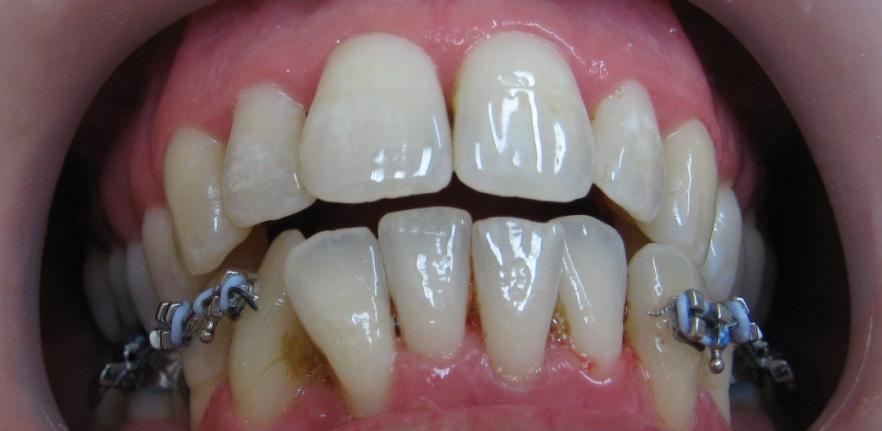 Po nasazení následovala instruktáž a demonstrace čištění zubů s fixním aparátem. Pacientka nacvičila techniky čištění společně s dentální hygienistkou.