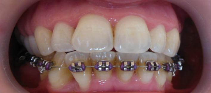 Obrázek 16 Stav hygieny po ošetření dentální hygienistkou