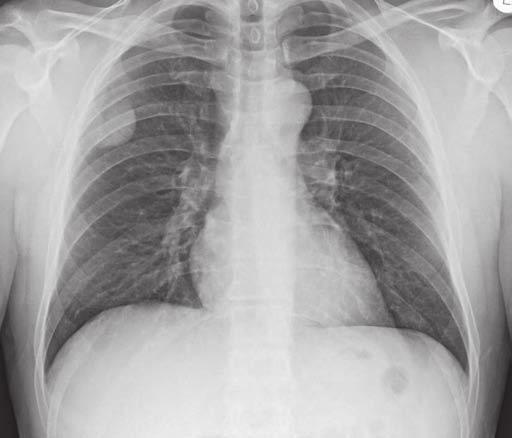 V rámci diagnostiky bylo provedeno vyšetření angio CT plic, kde byla kromě plicní embolie náhodně zjištěna expanze v pravém apexu hrudníku velikosti 42 38 32 mm v kontaktu s plící (obr. č.