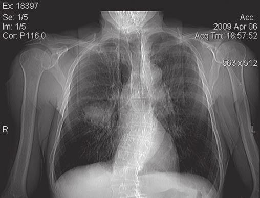 Zajímavé bronchologické (a morfologické) nálezy Pavel Bartoň 1, Zoltán Kerekes 2, Helena Hornychová 3, Jana Vejvodová 4 1 OLÚ Jevíčko 2 Patologie, s. r. o.