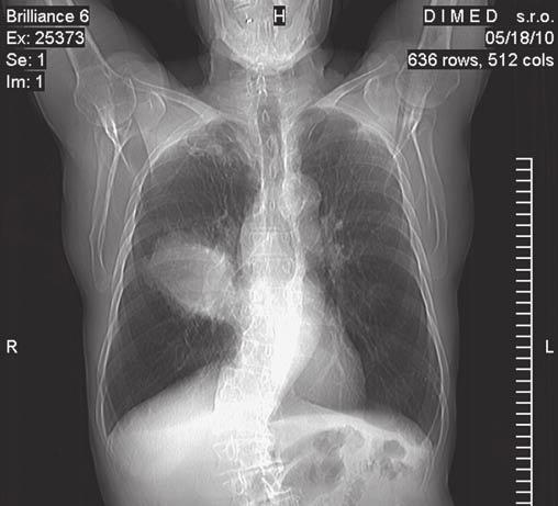 Zajímavé bronchologické (a morfologické) nálezy. 15. díl Syndrom středního laloku. Kazuistiky v alergologii, pneumologii a ORL 8, 1: 26 30, 2011. 15. díl Syndrom středního laloku Klíčová slova: flexibilní bronchoskopie (FOB) bronchoskopické nálezy syndrom středního laloku Případ 22.