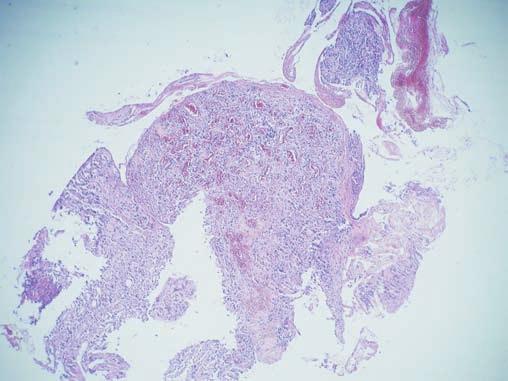 ZAJÍMAVÉ BRONCHOLOGICKÉ (A MORFOLOGICKÉ) NÁLEZY Obr. 22/15 17: Histologické vyšetření (FOB 24. 6. 2010) Obr. 22/15 Obr.