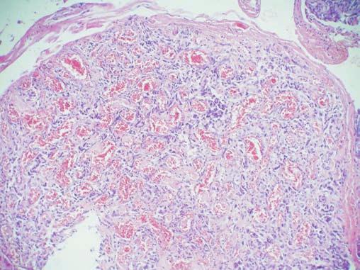 22/15 (zvětšení 10 ) Foto z archivu autorů Mikrobiologické vyšetření výplachu z bronchů: Streptococcus pneumoniae MLSB Qnr (citlivost: penicilin,