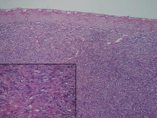 Pokud to topografické poměry dovolují, doporučeno odstranit celé ložisko a poslat na podrobné histologické vyšetření k upřesnění diagnózy. Nutné!