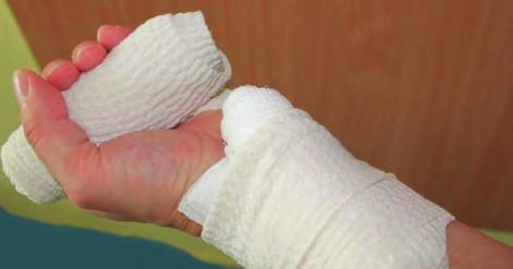 Po prosáknutí třetí vrstvy použijte škrtidlo. Škrtidlo používejte pouze v případech, kdy krvácení nelze zastavit jiným předchozím způsobem.