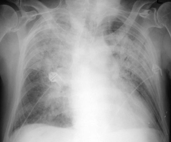 plicní edém alveolární signalizuje i tekutinu v alveolech > 30 mm Hg RTG obraz: - mnohotvárný, stěhovavý - skvrnité