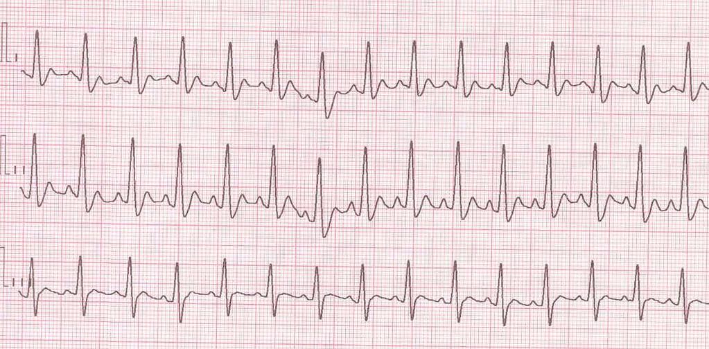 Electrocardiographic strip in