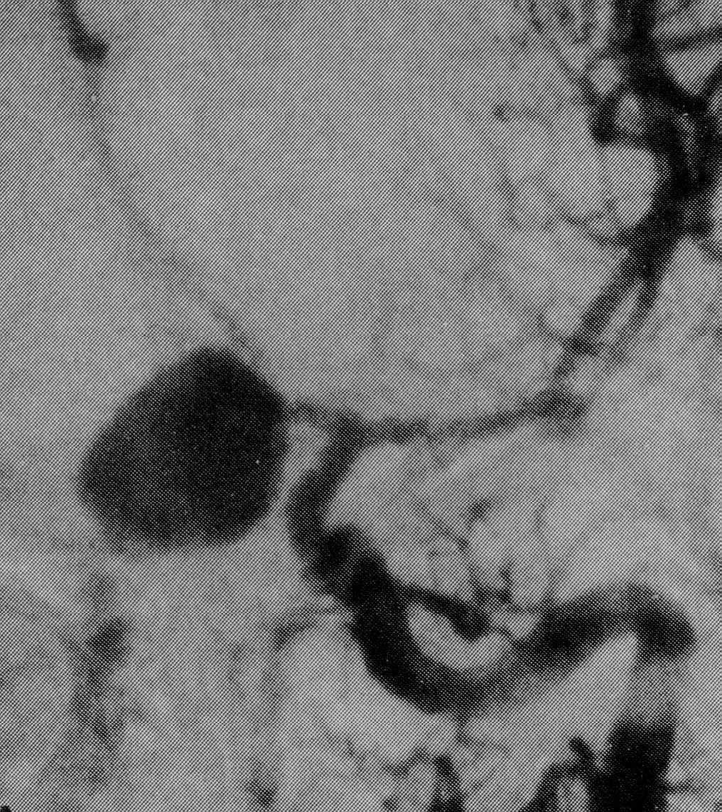 Tepenné aneuryzma - tvar váčku vystupujícího z cévy různě širokým krčkem -