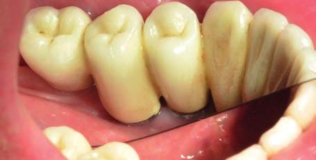 Pohled z lingvální strany, ústup alveolární sliznice v krajině implantátů v místech 44, 45.