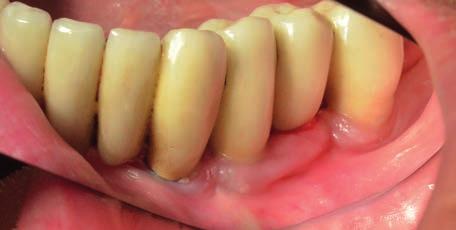vestibulární strany. Zjizvení alveolární sliznice v krajině implantátů v místě 44, 45.