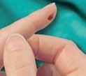 : Predisposing factors to phlebitis in patients with peripheral intravenous catheters: a descriptive study. J Am Acad Nurse Pract. 2008; 20(4): 172-80 13.