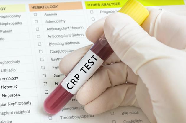 Prípadne je CRP možné vyšetriť pri odbere krvi zo žily, často to však býva spojené s vyšetrením ďalších krvných parametrov. Vtedy sa krv v skúmavke zasiela do laboratória na podrobnejšie vyhodnotenie.