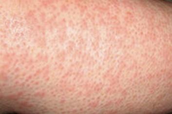 Den 7., 8. Thiopental 6.5.4.3 g/den.ex. ICP stabilní, v normě, 8.den extrakce ICP čidla Zornice 6..4mm, -/- Febrilie intermitentní max. 38,4 C Exantém na trupu a končetinách CTX ex., MER in.