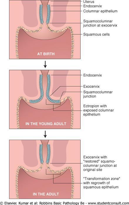 Ektropium V dětství cylindrický jednovrstevný epitel je pouze v endocervixu, na exocervixu je epitel dlaždicový V adolescenci cylindrický epitel přesahuje na exocervix, kde vytváří