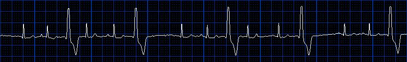 Ventrikulární bigeminismus, trigeminismus, zrychlený ventrikulární
