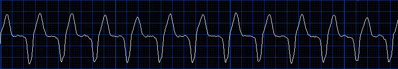 (RTG, echo, Holter, srdeční biomarkery) - jinou diagnostiku LÉČBA: -