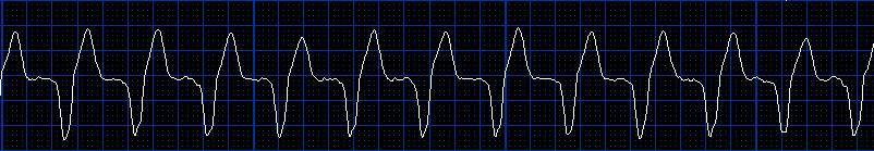 (RTG, echo, Holter, srdeční biomarkery) - jinou diagnostiku LÉČBA: -