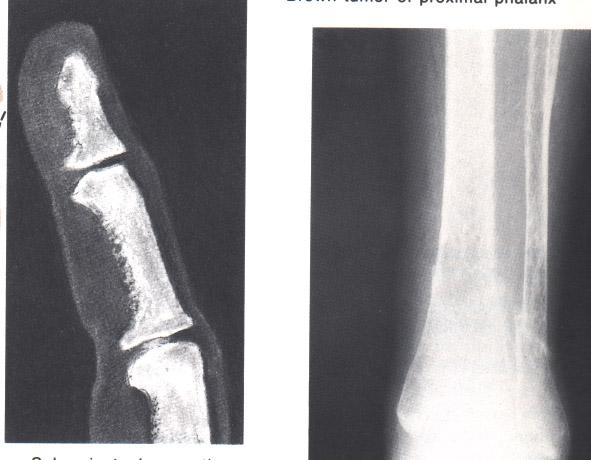 Sek. HPT u renálních chorob - renální osteodystrofie Bolest v kostech, únava, obtížné vstávání ze sedu,