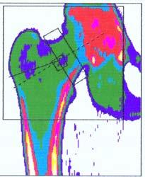 DEXA Dual Energy Absorptiometry BMD v g/cm 2