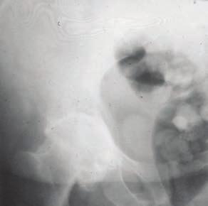 Osteomalácie - RTG difuzní rarefakce skeletu struktura jako set$elá
