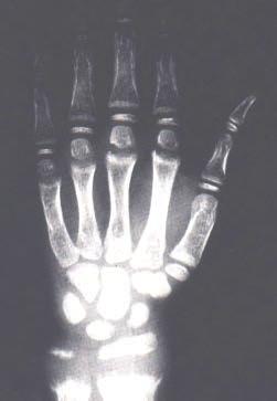 1. Nedostatek vit. D 2. Nedostatek fosfát" Rachitis- k$ivice Porucha mineralizace novotvo#eného osteoidu Kost je m'kká, m"%e se oh!