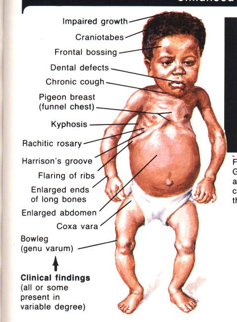 Rachitis- křivice Léčba Vitamín D 500-1000 IU/den po dobu 10 týdnů Ozařování horským