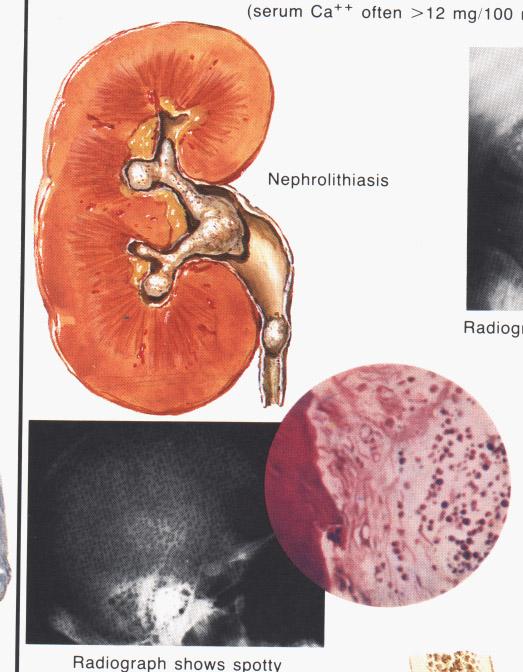 Primární HPT Nefrolithiasis, polyúrie, polydypsie Osteodystrofia fibrosa cystica generalisata GIT potíže