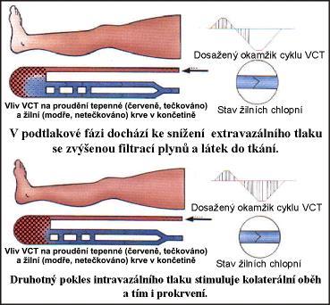 Fáze přetlaku je periodicky střídána s fází podtlaku (obr. 1.4), při níž je účinně podporován přítok krve i skrze arteriální řečiště postižené stenózami a obliteracemi.
