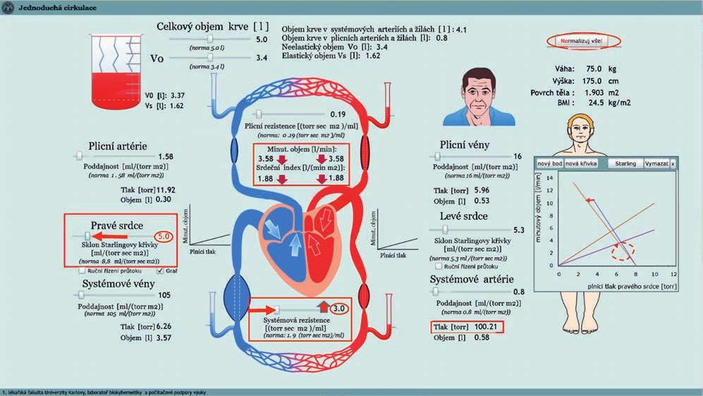 Obr. 5-6.27 Simulace akutního selhání pravého srdce vliv zvýšení periferní systémové rezistence. Nejprve normalizujeme všechny parametry a pak snížíme sklon Starlingovy křivky pravého srdce.