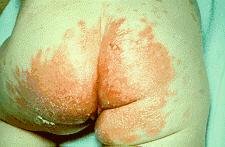 Candida albicans Kandidózy kůže a nehtů vznikají v místech vlhké zapářky (pod prsy, v podpaží, v tříslech, mezi prsty, na