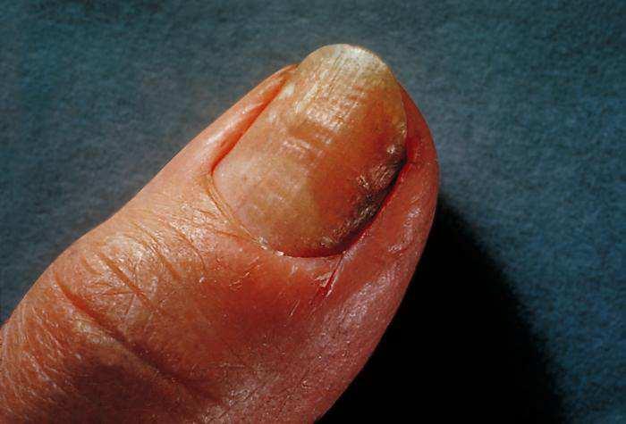 Candida albicans Kandidózy kůže a nehtů Kandidové paronychium - postihuje osoby