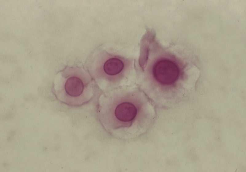 Rod Cryptococcus suchý roztěr, barvení Gomori- Grocott (foto: Prof. MUDr.