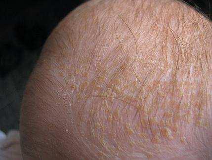 Rod Malassezia (dříve Pityrosporum) Seberoická dermatitida (SD) chronicky probíhající dermatóza vázaná na oblast