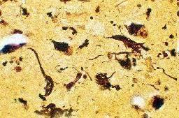 Alzheimerova choroba - patogeneze degenerace τ-proteinu neurofibrilární klubka www.zdn.
