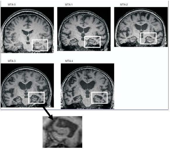 Alzheimerova demence zobrazovací metody obraz atrofie zejm.