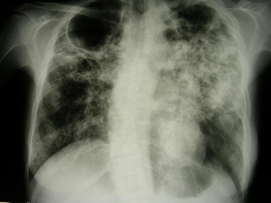 Tuberkulóza u primárně imunokompetentníh o pacienta s chronickým