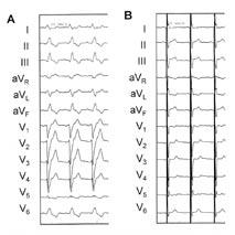 Obrázek 1. Ukázka 12svodového EKG záznamu od nemocného s pokročilou formou CHSI: A. před implantací a B. po implantaci biventrikulárního stimulačního systému.