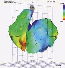 130 ms. Obrázek 2. Ukázka trojrozměrných map obou srdečních komor pořízených tzv. elektroanatomickým mapovacím systémem (tj.
