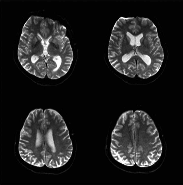 v akinetický mutizmus. Neuropatologické vyšetření mozku pacienta bylo provedeno v Národní referenční laboratoři lidských prionových onemocnění.