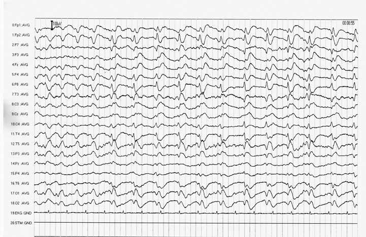 173 Obr. 3. EEG periodické trifázické vlny a specifický. Navíc při symptomatické anxiolytické léčbě (diazepam perorálně) došlo ke zmírnění subjektivních potíží.